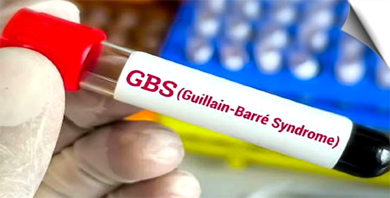 मप्र: मंदसौर में GBSसंक्रमण के 4 मामले आए सामने